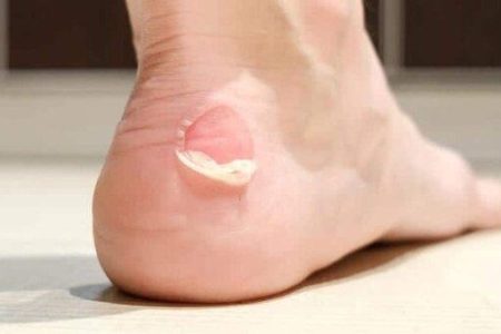 پوست «تاول» پا را نکنید