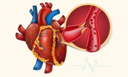 تری گلیسیرید نرمال چقدر است؟ علائم و روش درمان تری گلیسیرید بالا