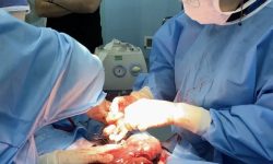 عمل جراحی فوق تخصصی خروج توده ۲/۵ کیلویی از شکم دختر ۱۱ ساله
