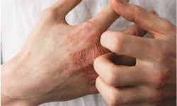 چند راهکار طبیعی برای پیشگیری از «خشکی پوست» در فصل سرما