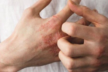 چند راهکار طبیعی برای پیشگیری از «خشکی پوست» در فصل سرما