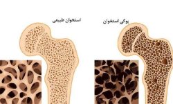 پوکی استخوان از دهه چهارم زندگی شروع می‌شود