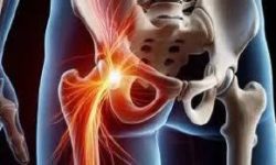 سیاتیک را با گرفتگی عضلات اشتباه نگیرید