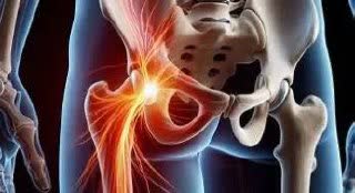 سیاتیک را با گرفتگی عضلات اشتباه نگیرید