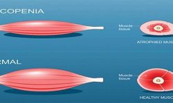 وقتی تحلیل عضلات، استقلال فردی را می‌گیرد