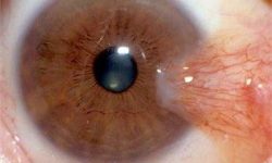 بیماری ناخک و راه های پیشگیری و درمان این بیماری