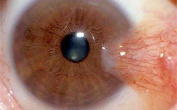 بیماری ناخک و راه های پیشگیری و درمان این بیماری