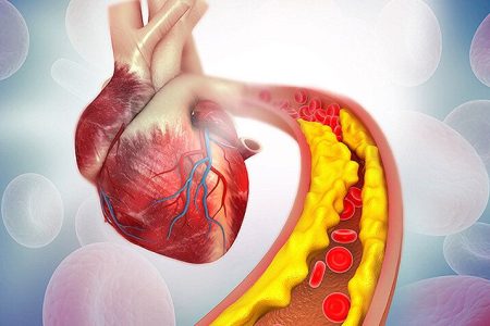 آیا باید از کلسترول و تری‌گلیسیرید بالا ترسید؟/ عوامل بالا برنده کلسترول و تری‌گلیسیرید خون را بشناسیم